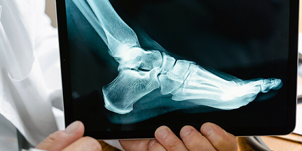Plantar Fasciitis